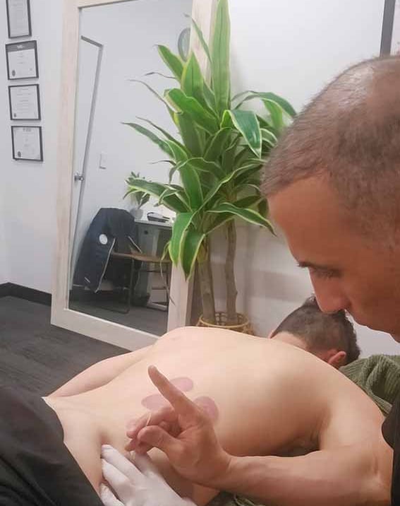 live view of dry needling being performed by accredited massage therapist Moe at Advance Body Massag