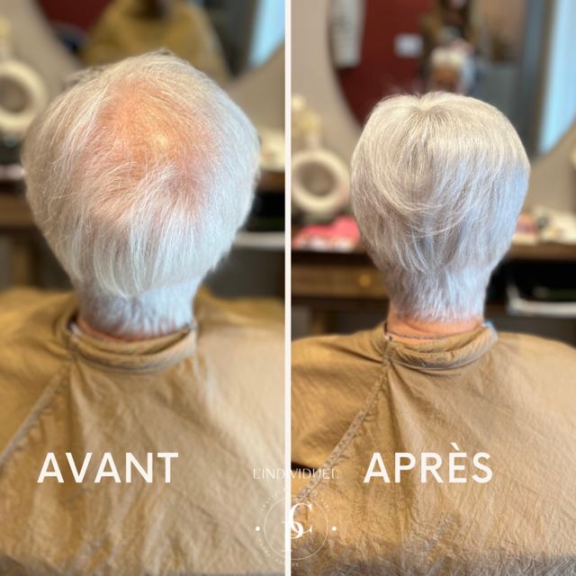 perte de cheveux femme