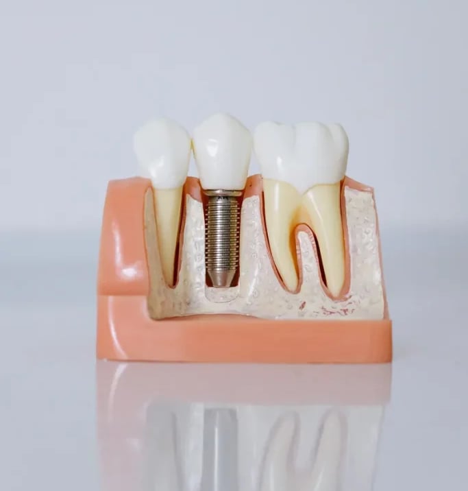  Implantes dentales en Sevilla