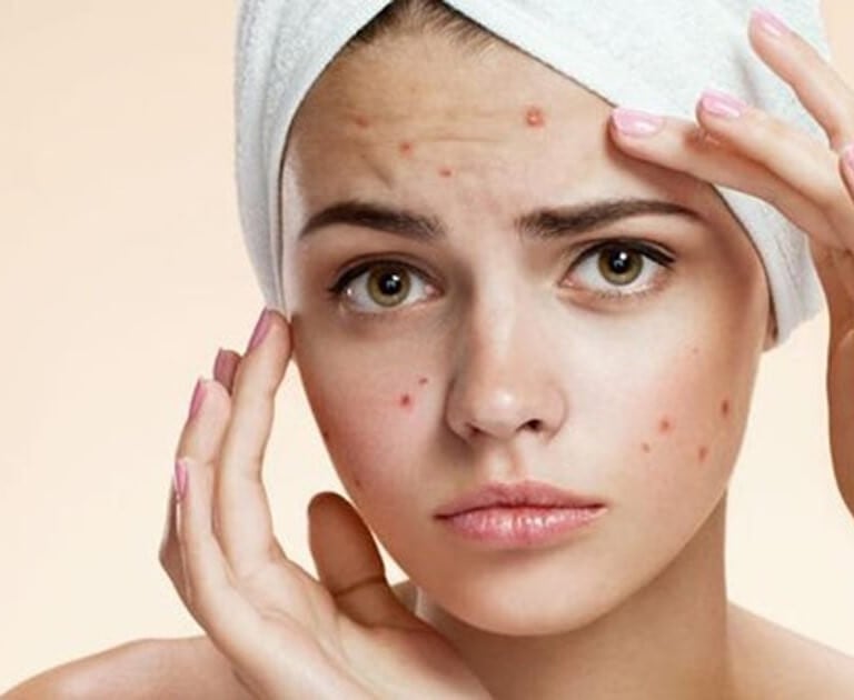 a woman getting a acne injection