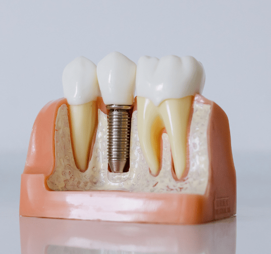 Tratamento de implantes dentários na Clínica do Convento, Setúbal – Recupera o teu sorriso.