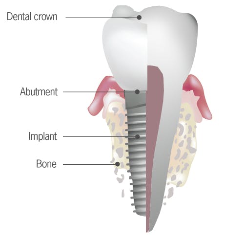 Best Dental Implants treatment in Wadgaon sheri pune