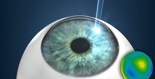 LASIK-Secunderabad-Nexus-Vision