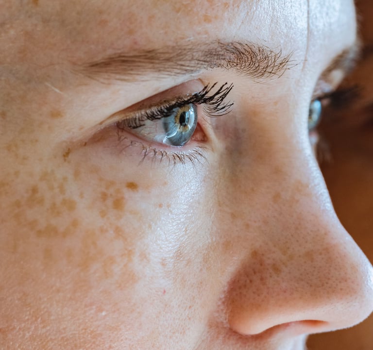 ojeras murcia laser ipl ojeras eliminación ojeras murcia tratamiendo acido hialuronico vitamina c