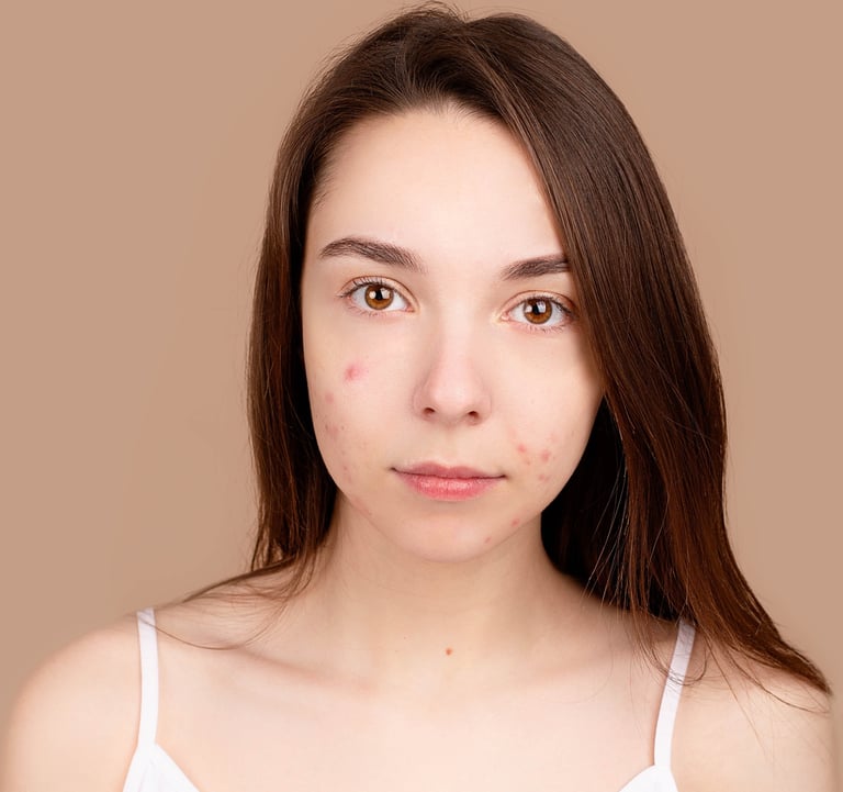 acné tratamiento láser hormonas topico oral formulas estética iMujer microneedling holistica peeling