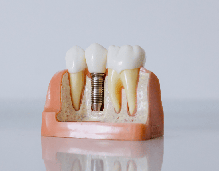 Implantologia avançada em Setúbal, recuperação do sorriso com implantes dentários fixos e seguros.