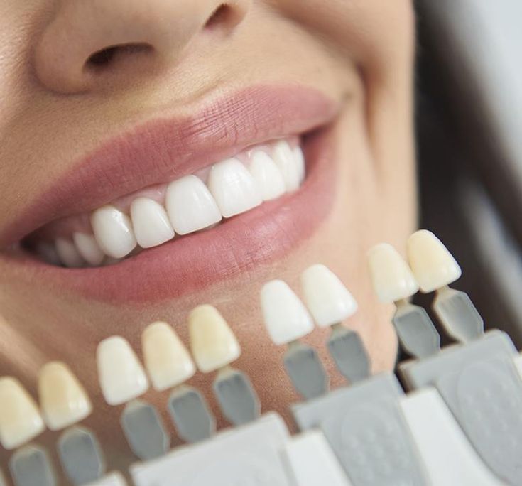 Branqueamento dentário profissional em Setúbal para um sorriso mais branco e brilhante.