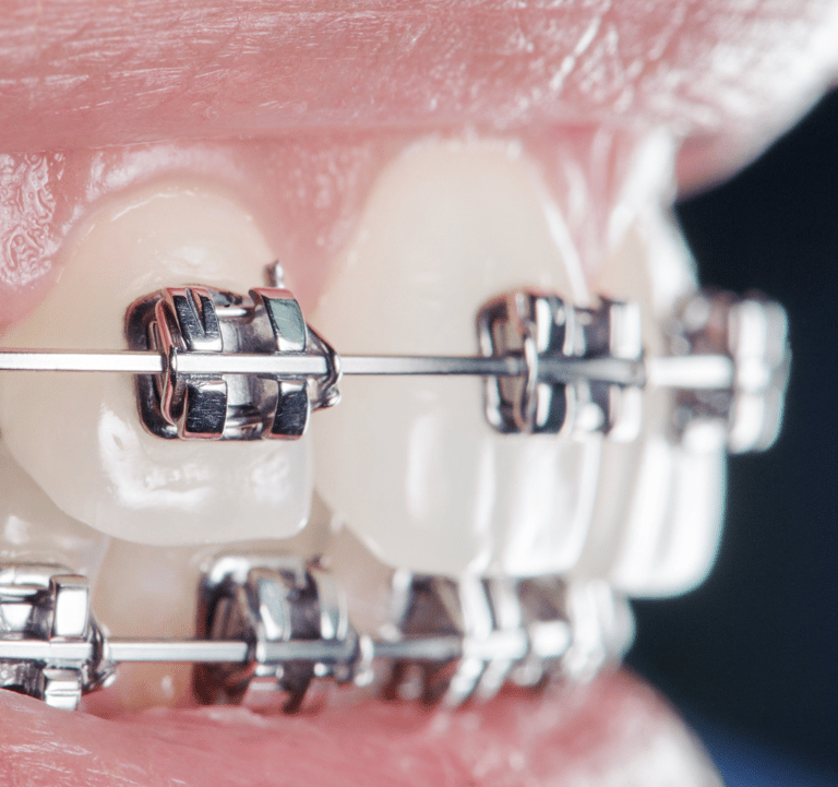 Ortodontia em Setúbal, aparelhos fixos e alinhadores invisíveis para um sorriso perfeito