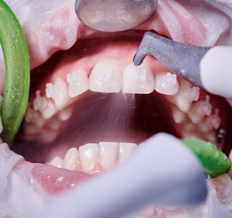 Higiene e saúde oral em Setúbal, prevenção de cáries e doenças gengivais com limpeza profissional