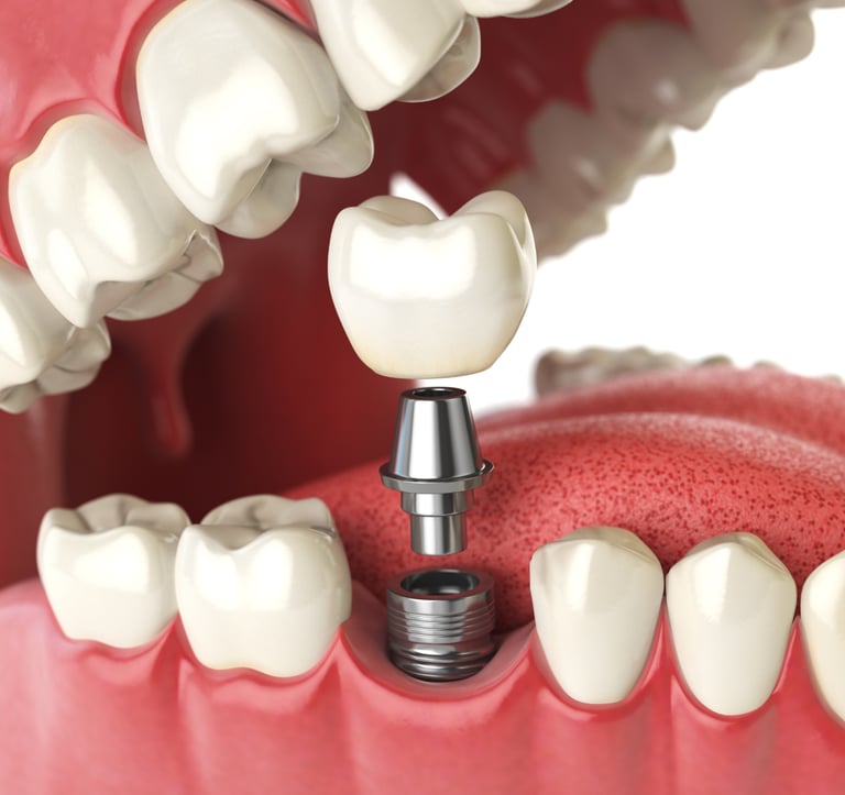 Clínica de implantologia em Setúbal, especialistas em implantes dentários modernos.