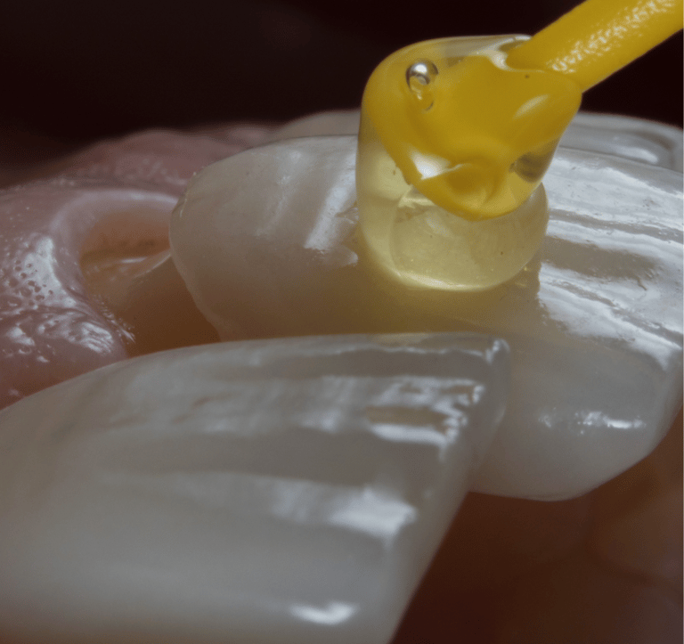Clínica especializada em tratamento de facetas dentárias em Setúbal.
