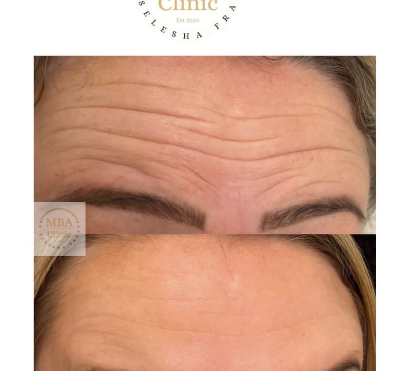 Botox and fillers in Hull 