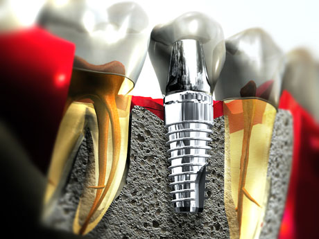 single dental implant cost in Jarabacoa 