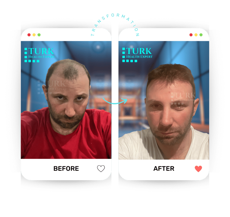 Celebrities Hair Transplant