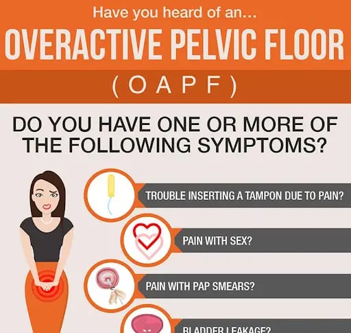 A poster showing the four symptoms of overactive pelvic floor