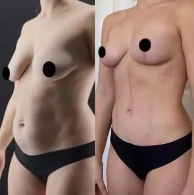 breast reduction before after photos
