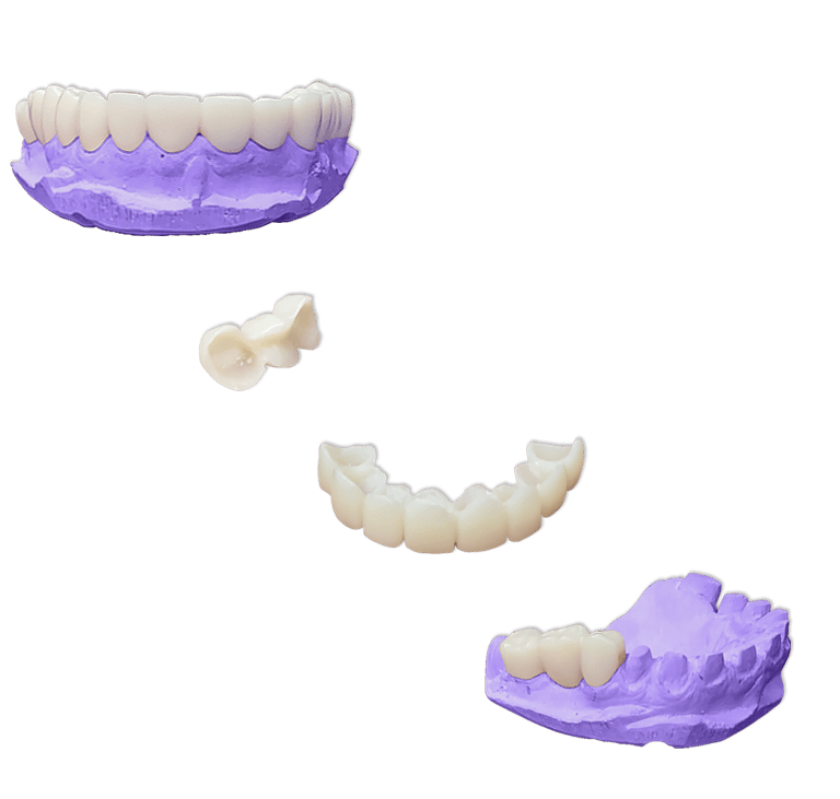 Protesis-Fija-Provisional-Acrilico-Rapido