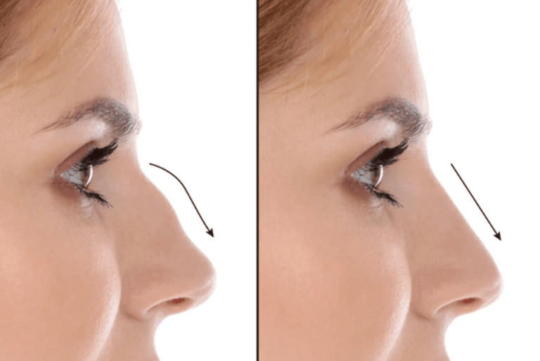 Rinomodelação sem cirurgia para corrigir imperfeições no nariz com ácido hialurónico em Setúbal.