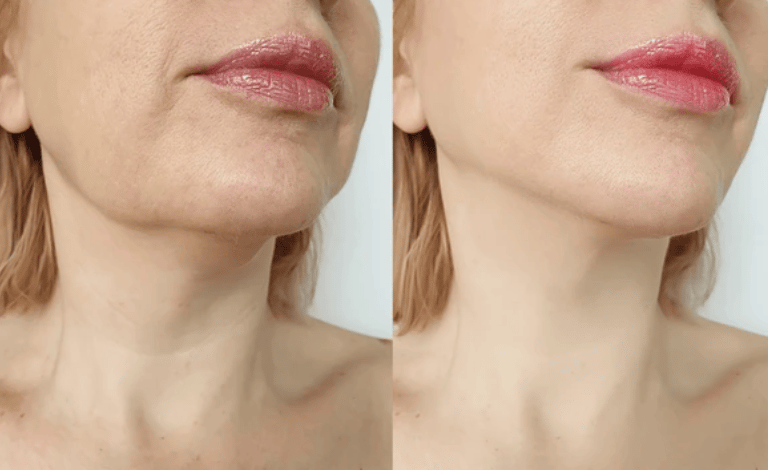 Harmonização do contorno facial com preenchimento de mandíbula na clínica médica e estética em Setúb