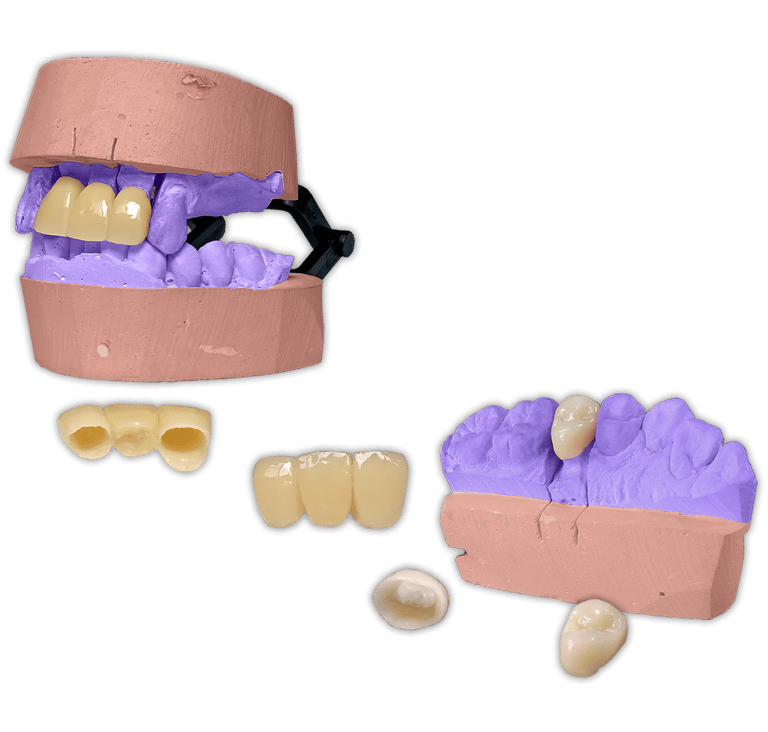 Protesis-Fija-Estetica-Acrilico-Ivocron