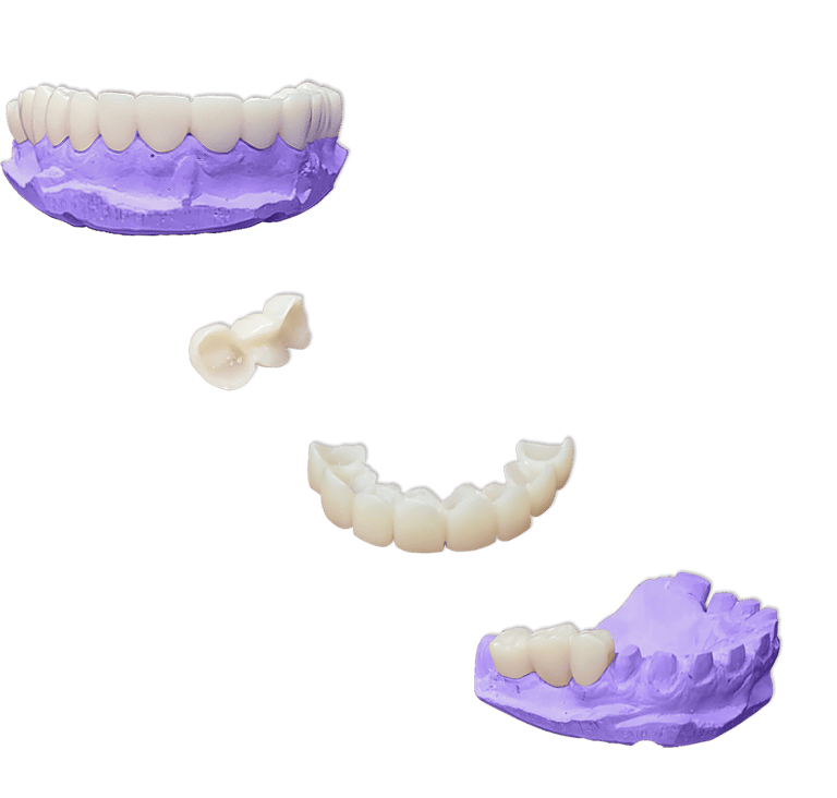 Protesis-Fija-Provisional-Acrilico-Rapido