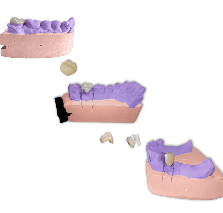 Protesis Fija Estetica Ceromero Signum