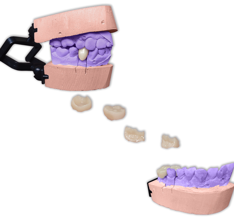 Protesis Fija Estetica Ceromero Sr Nexco