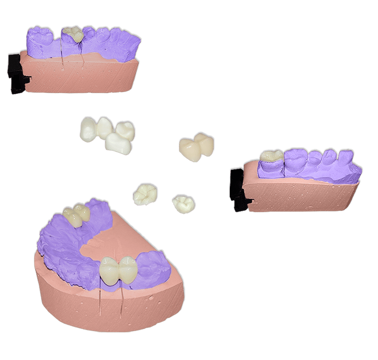 Protesis Fija Estetica Disilicato de Litio e.max Press