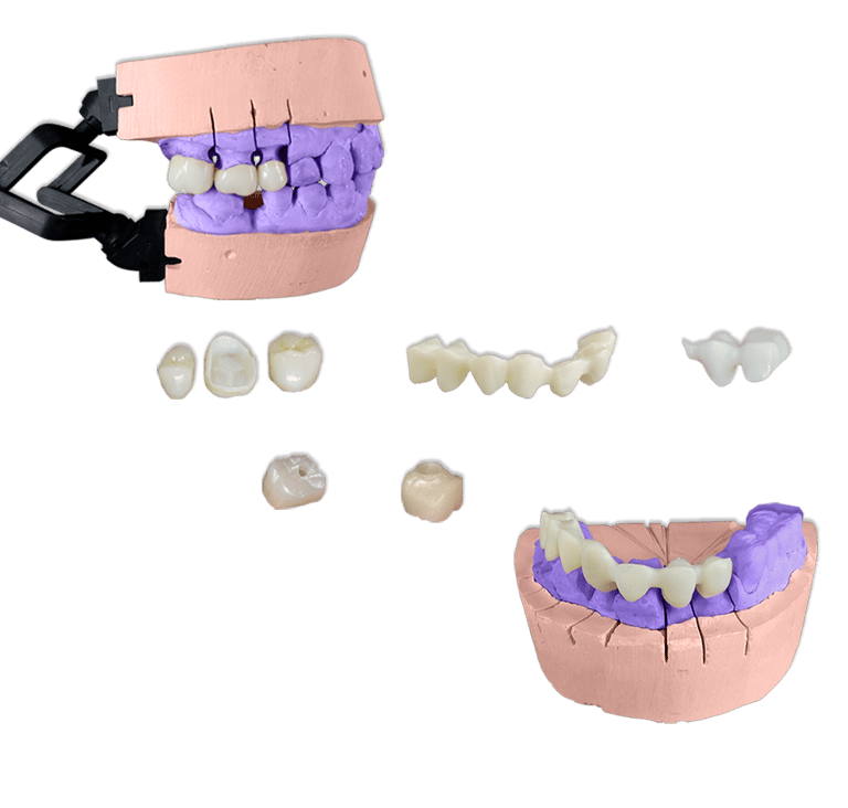 Protesis Fija Estetica Zirconia
