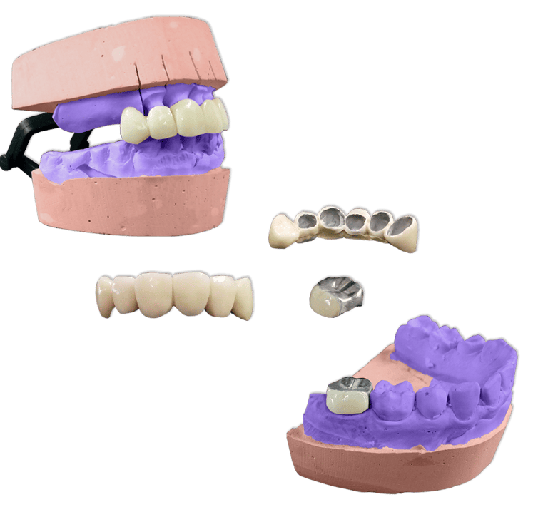 Protesis Fija Metal Acrilico Ivocron