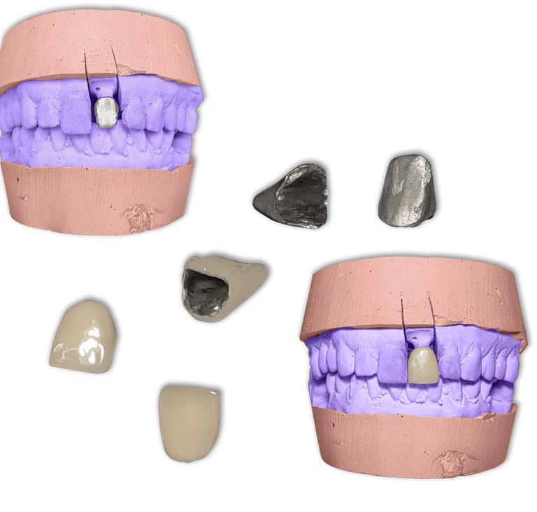 Protesis Fija Metal Ceromero Signum