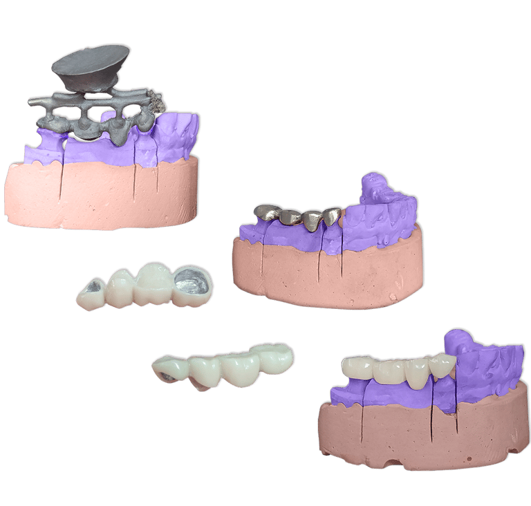 Protesis Fija Metal Ceromero SR Nexco
