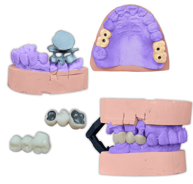 Protesis Fija Metal Porcelana IPS InLine