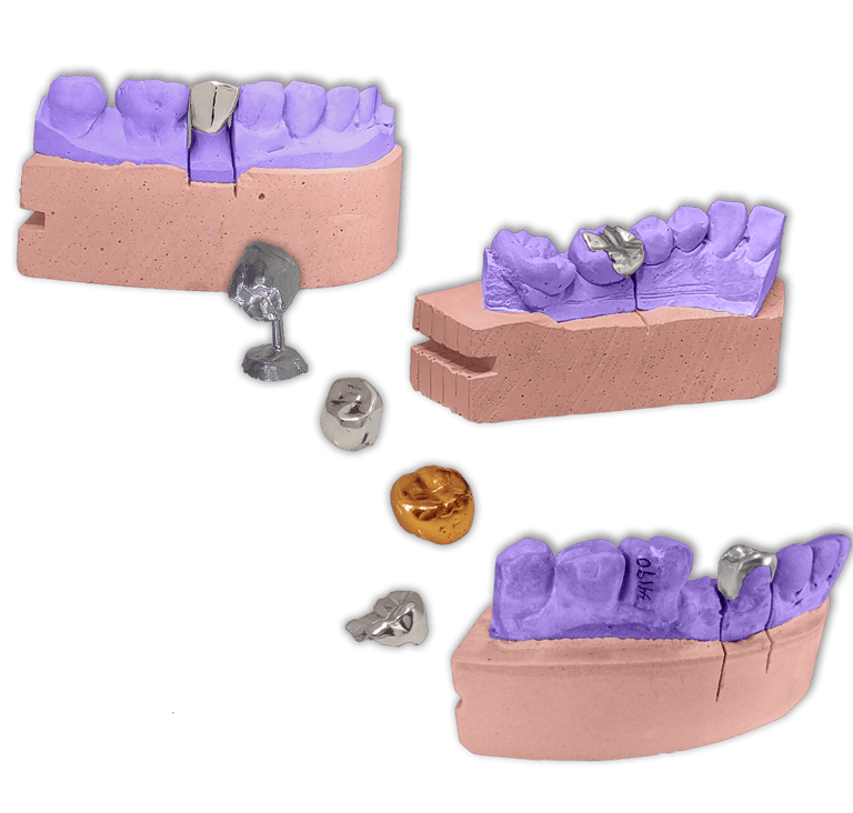Protesis Fija Total Metalicas