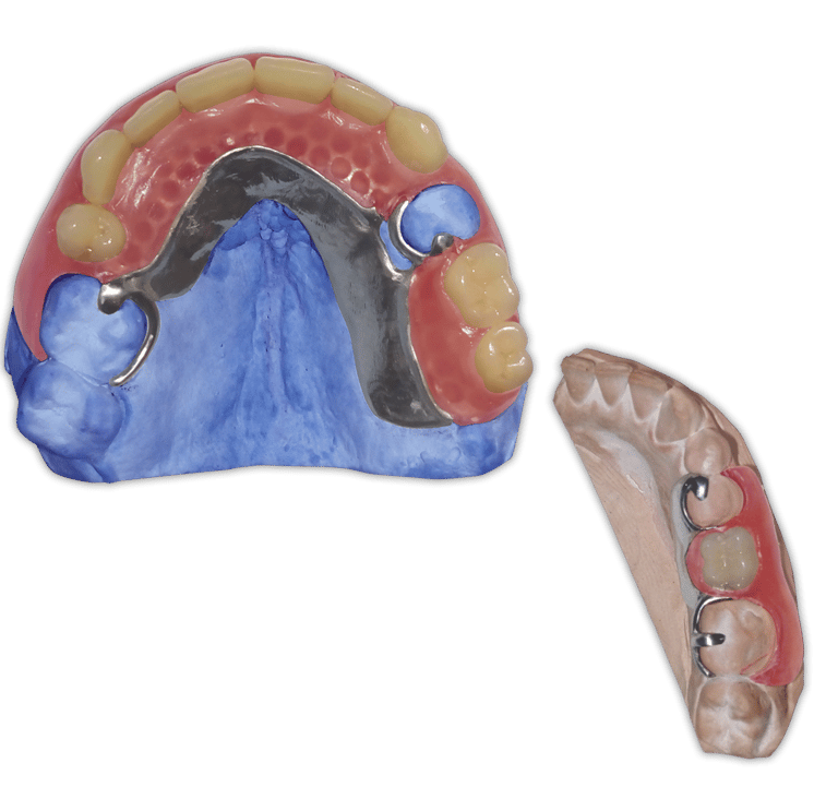 Protesis-Removible-Hibrida-Metal-Flexible-Valplast
