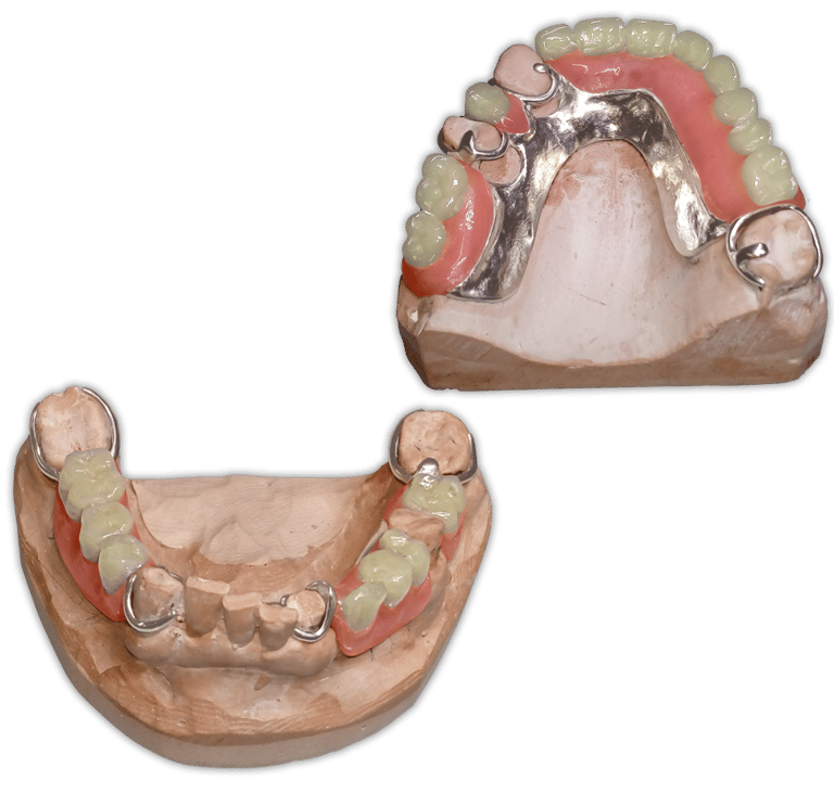 Protesis-Removible-Metal-Acrilico