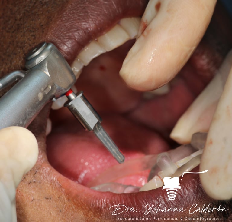 colombia dental implants