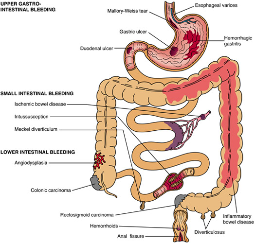 Gastrointestinal (GI) bleeding GASTRO FOUNDATION