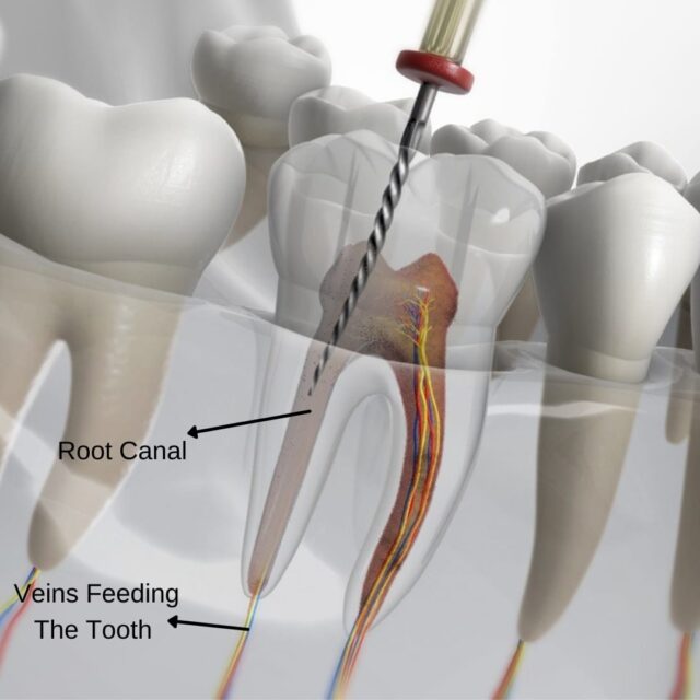 a image showing cleaning pulp in root canal treatment
