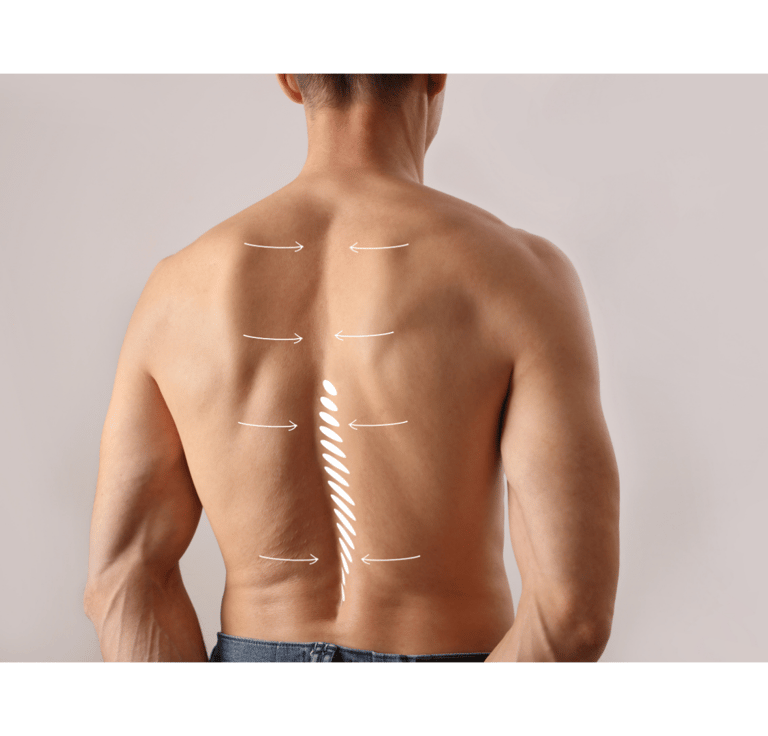 colonna vertebrale su un paziente