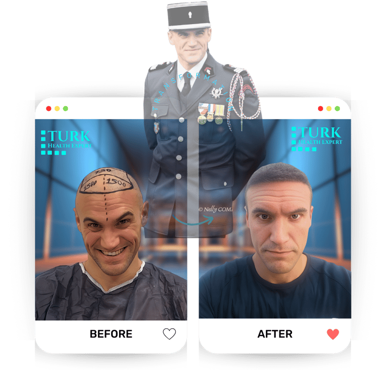 firefighter hair transplant before after