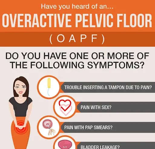 A poster showing the four symptoms of overactive pelvic floor