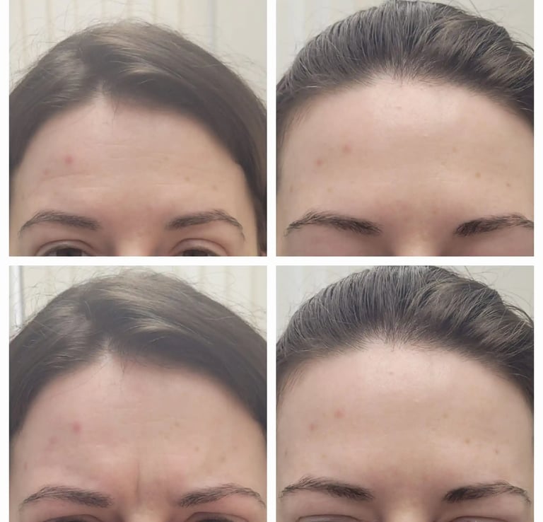 Dysport injection at Ariana Esthetic in Edmonton