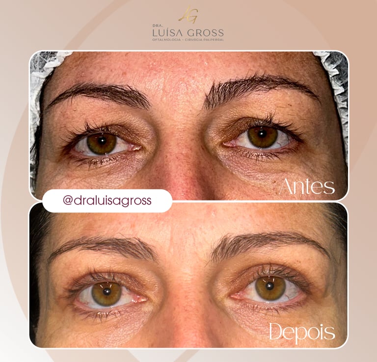 Antes e depois de cirurgia periocular realizada pela Dra. Luisa Gross