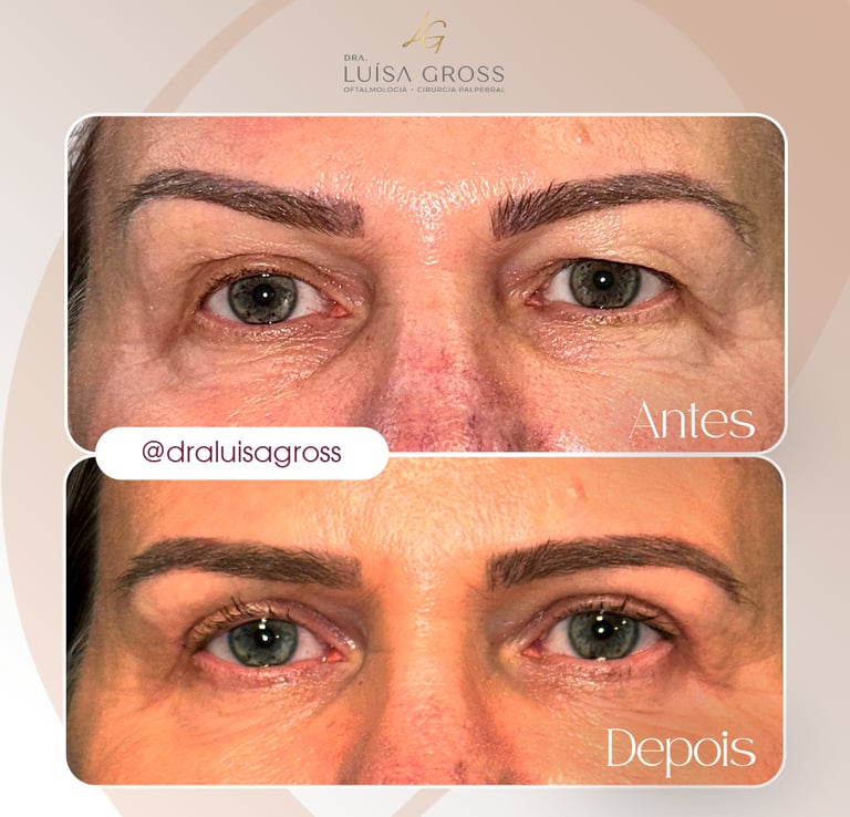 Antes e depois de cirurgia periocular realizada pela Dra. Luisa Gross