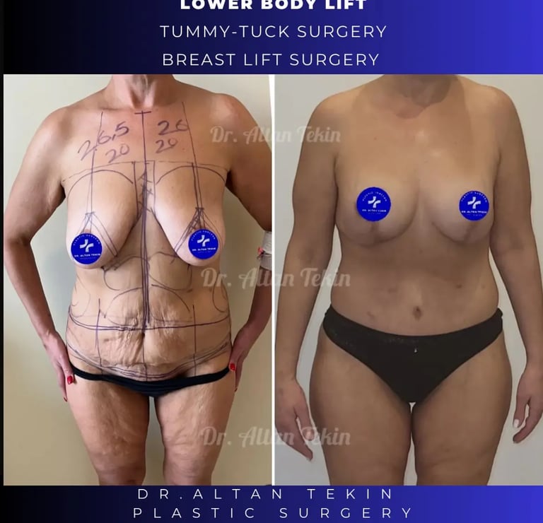 mommy makeover before after photos in Antalya, Türkiye