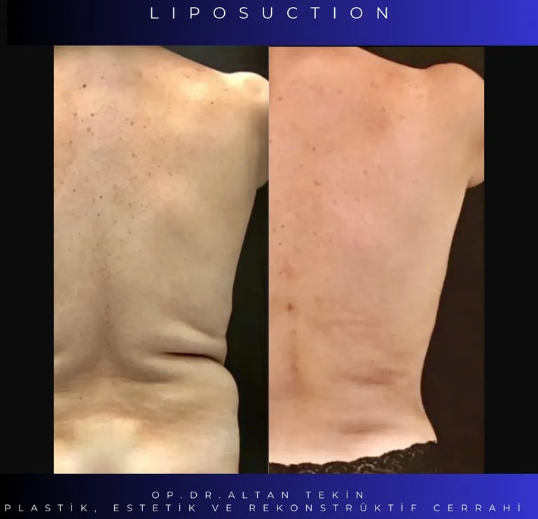 liposuction before after photos, Antalya