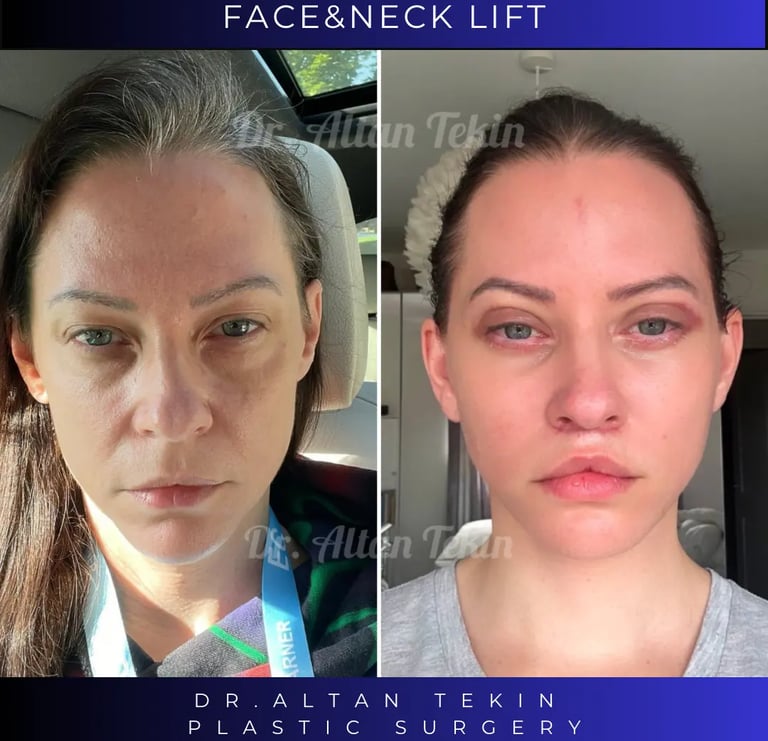 Augenlidoperation vorher und nachher