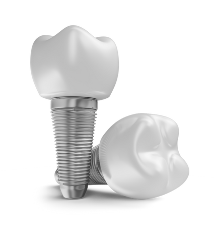Implante dentário em São Mateus do Sul