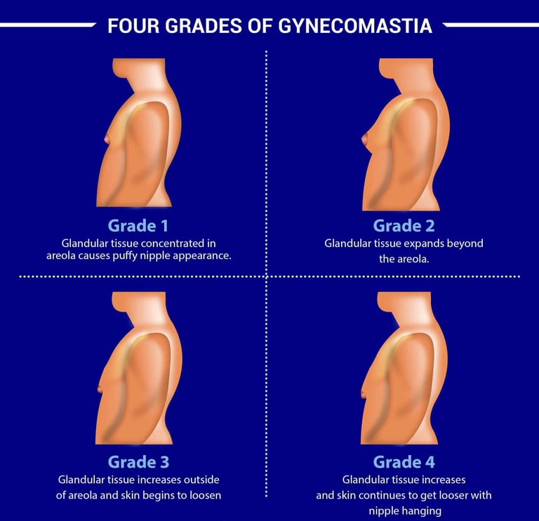 gynecomastia